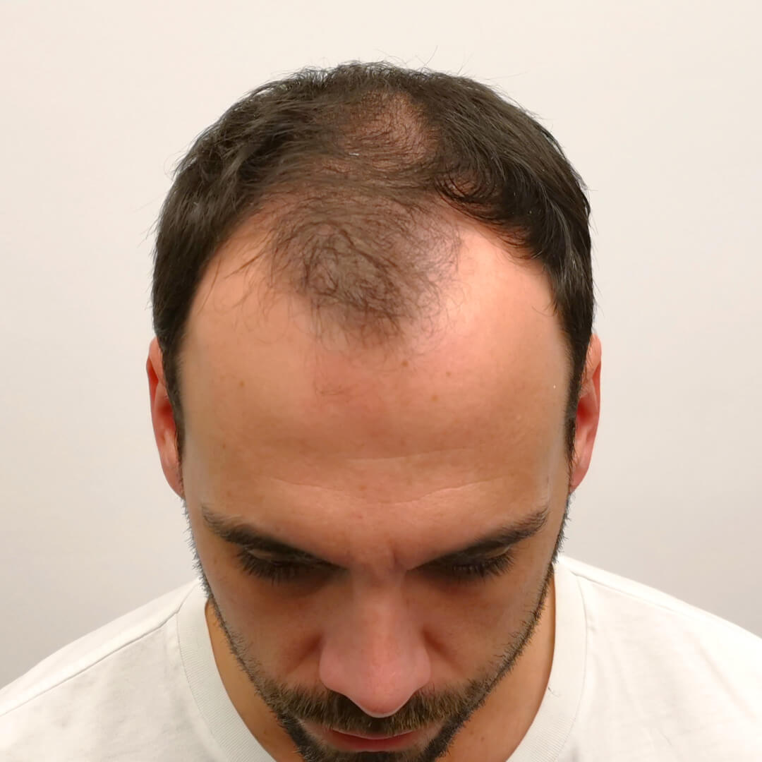 Hajbeültetés előtte-utána: Gergő - HIMG hajbeültetési klinika