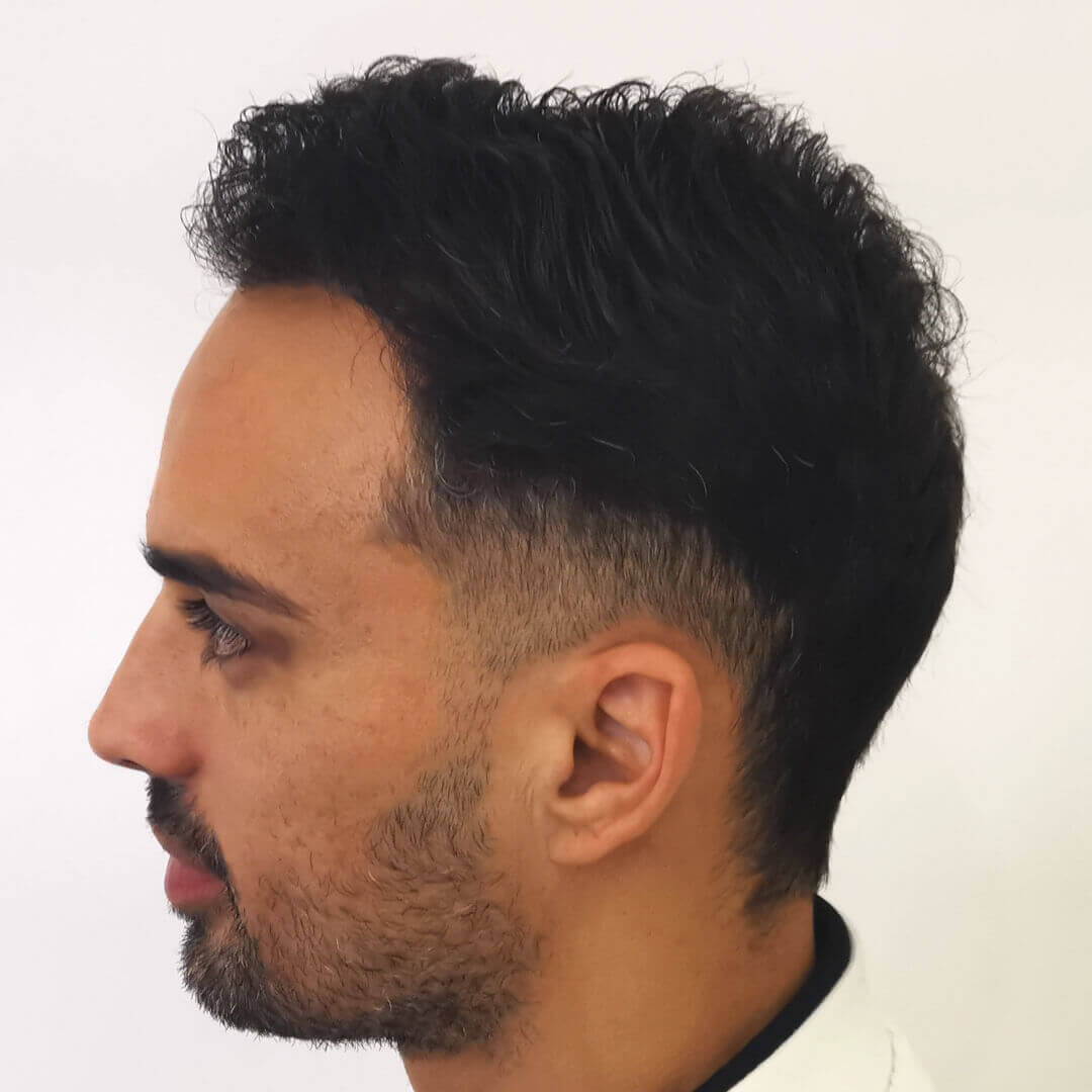 Hajbeültetés előtte-utána: M.D. Bertucci Lucas - HIMG hajbeültetési klinika