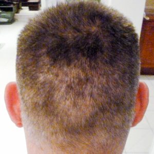 Hajbeültetés utáni eredmény