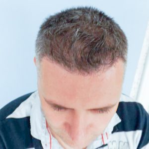 Hajbeültetés utáni eredmény