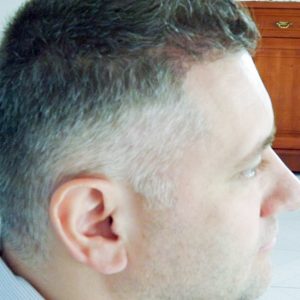 Hajbeültetés utáni eredmény