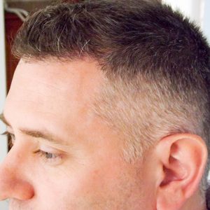 Hajbeültetés utáni eredmény