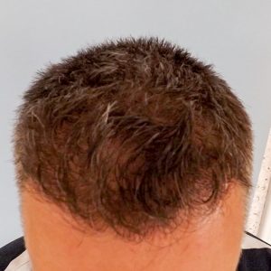 Hajbeültetés utáni eredmény